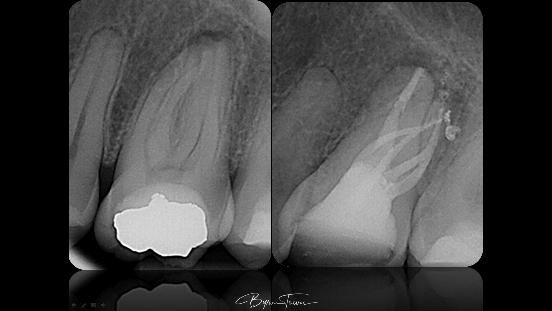 Complex Anatomy - Case 16
